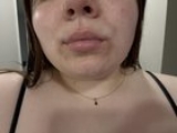 [Product Request] hyperpigmentation