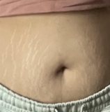 Stretch Marks [Product Request]